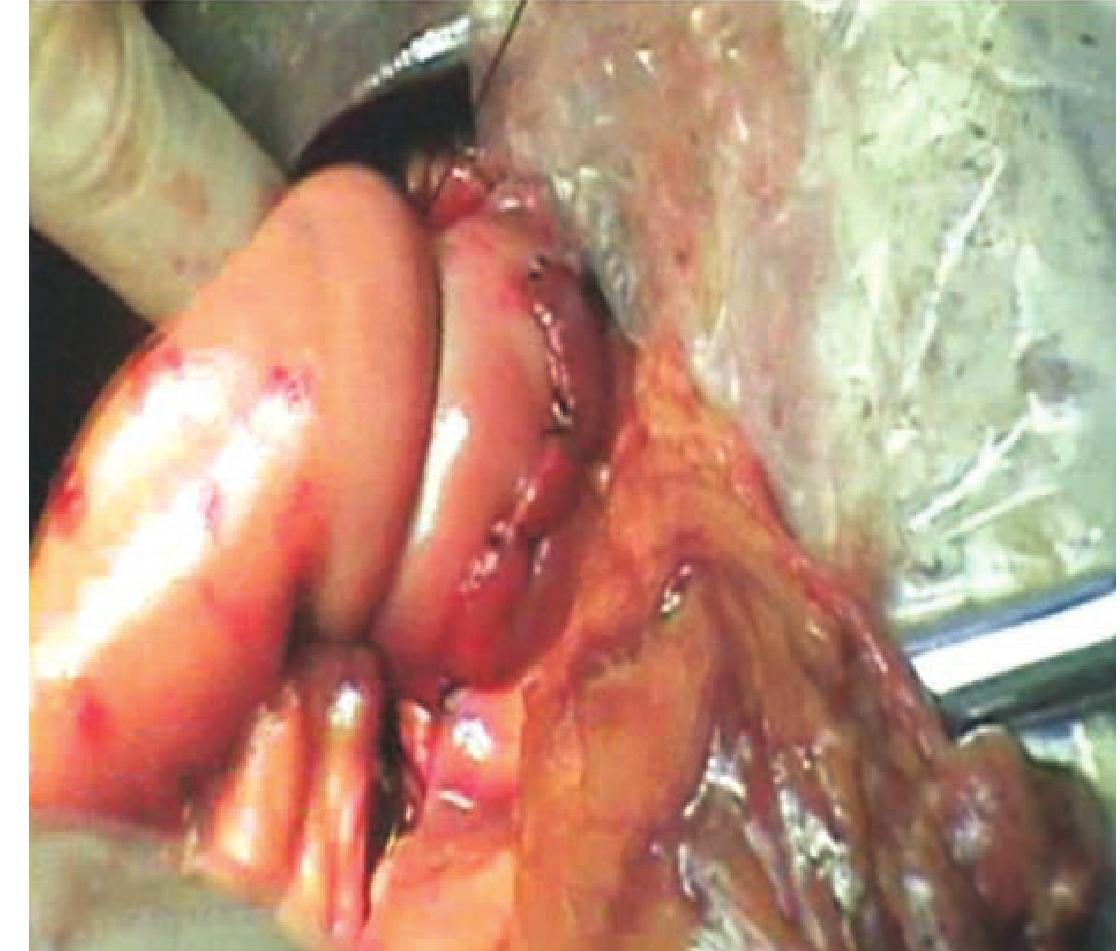 四、捆綁式胰腺空腸吻合