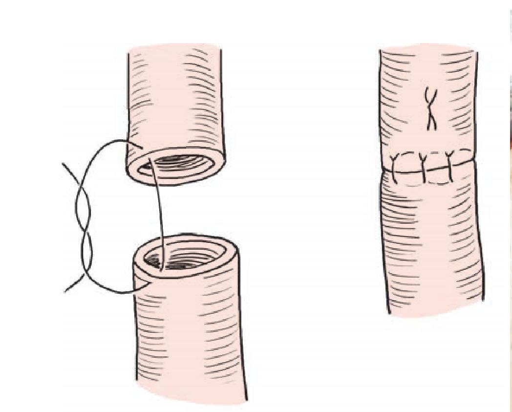 二、输尿管—输尿管端端吻合术