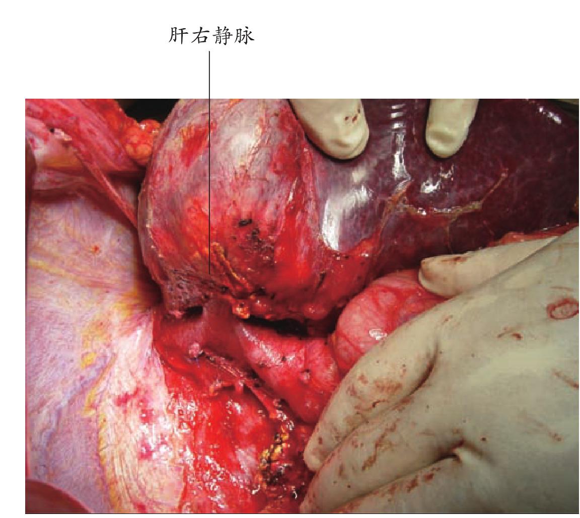 第五节 肝脏手术显露