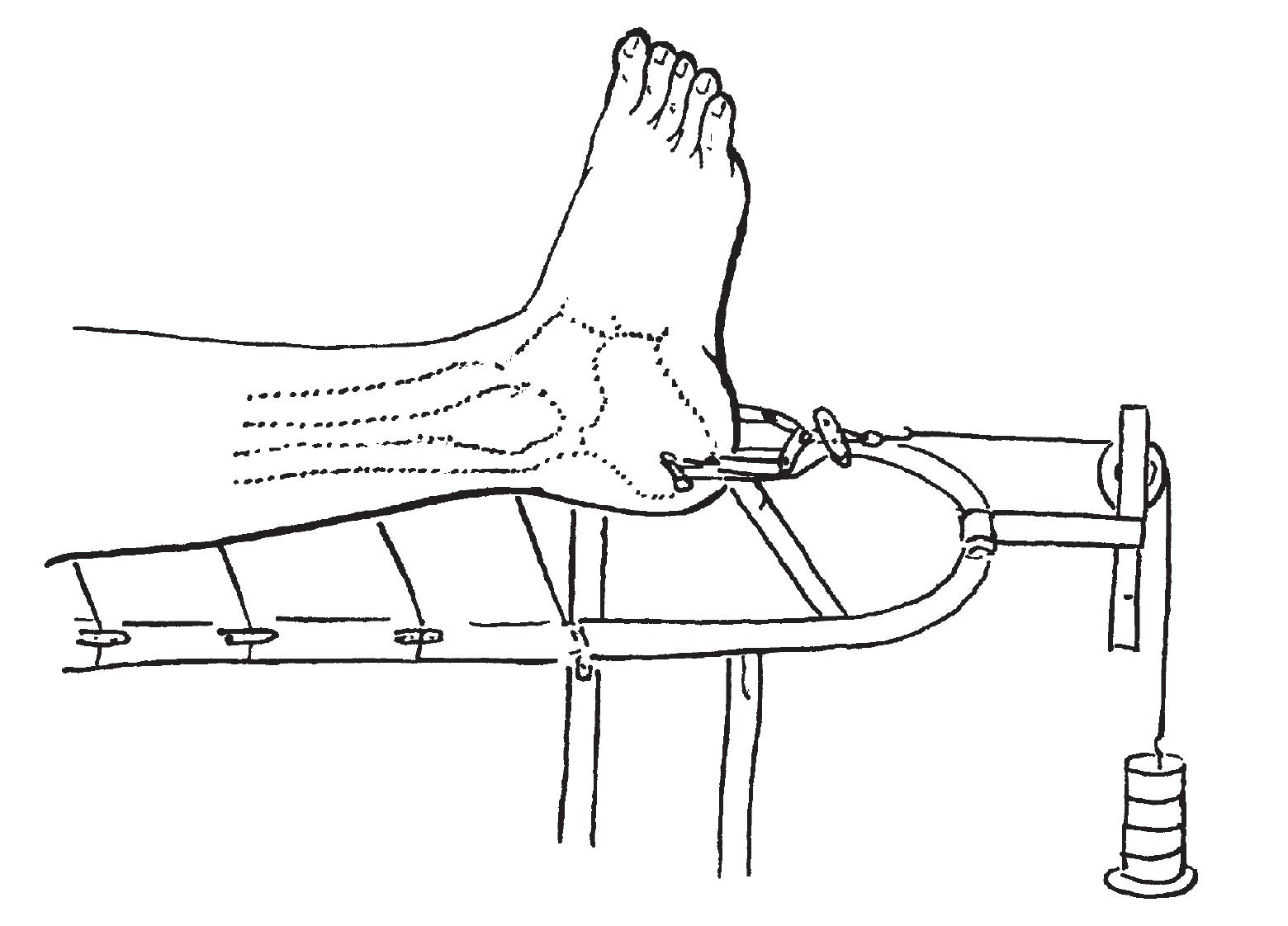 8 跟骨牵引术