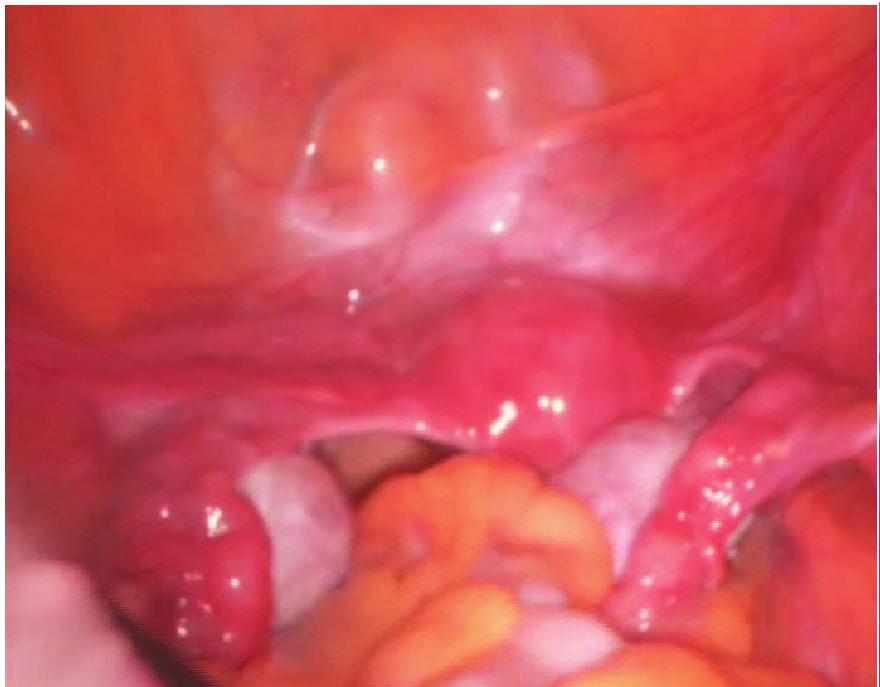 三、腹腔镜多囊卵巢打孔术实例精选