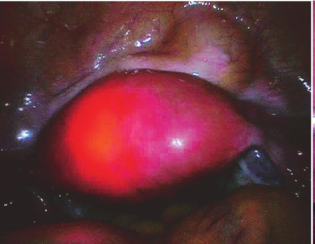 三、宮腔鏡和腹腔鏡聯(lián)合手術的手術方法