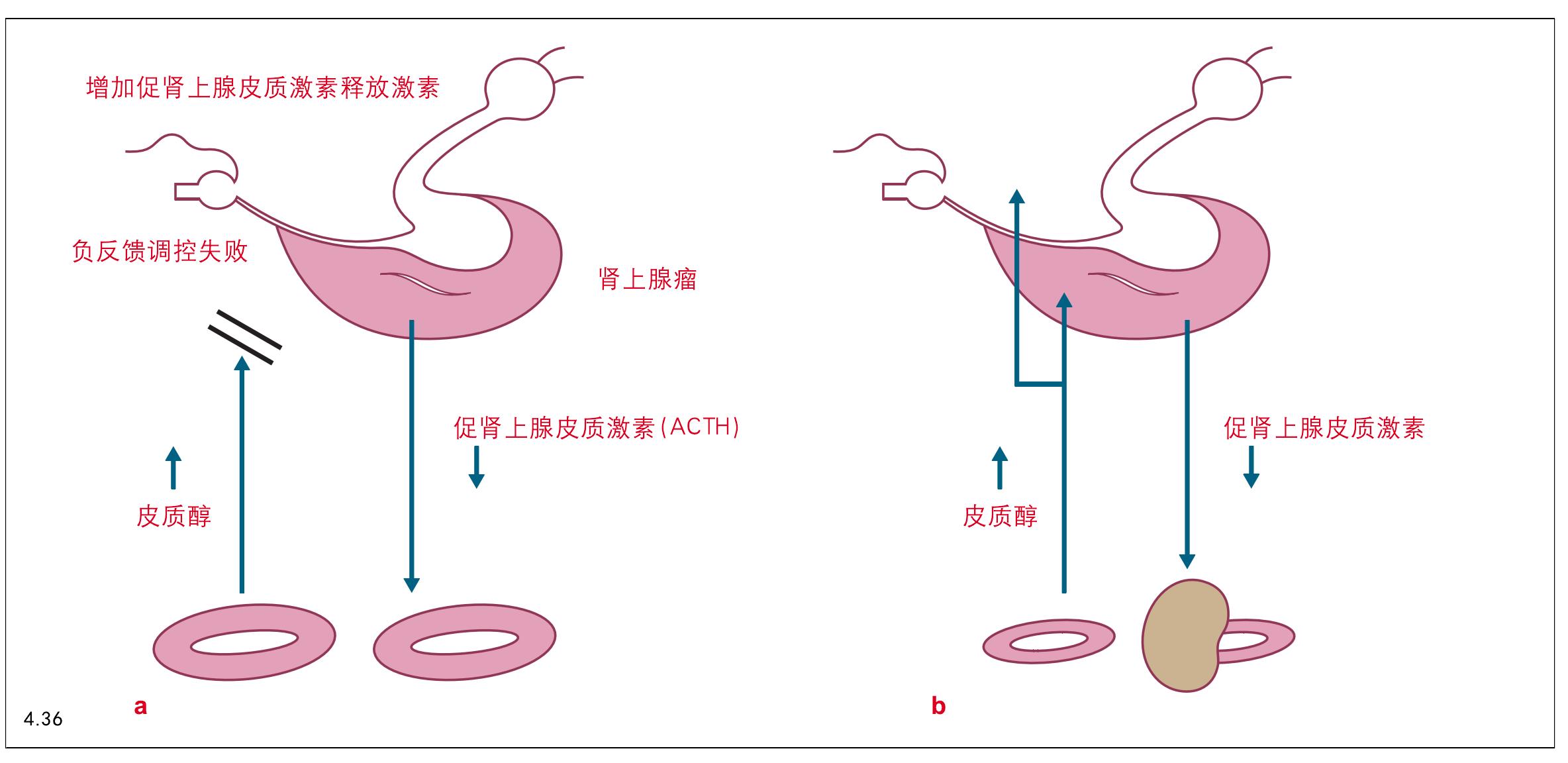 2. 肾上腺皮质功能亢进（库欣氏综合征）