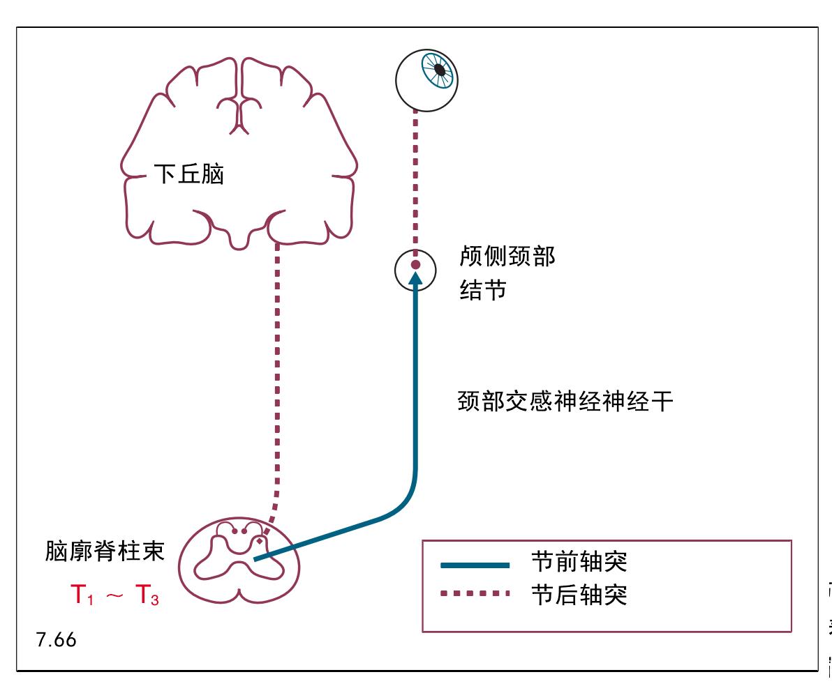 2. 霍纳氏综合征