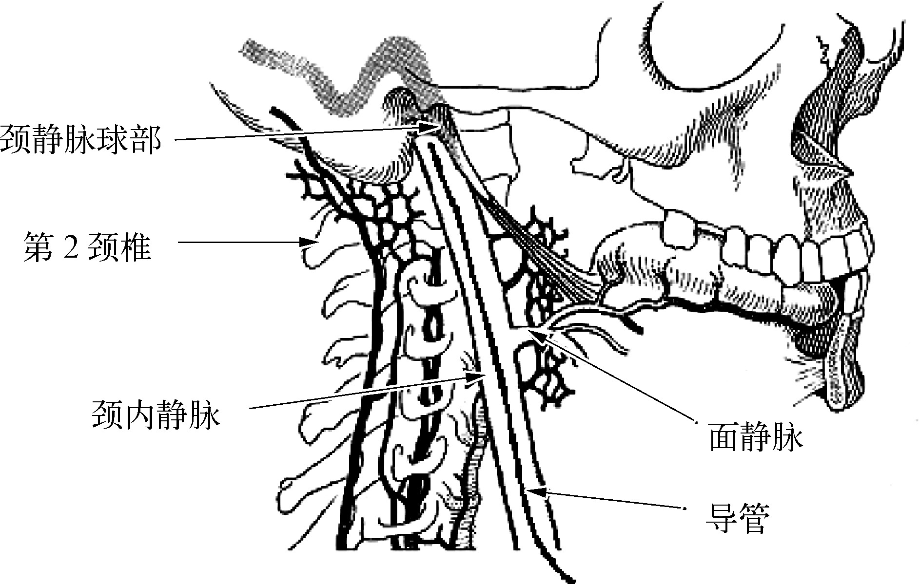 颈静脉球解剖位置图片