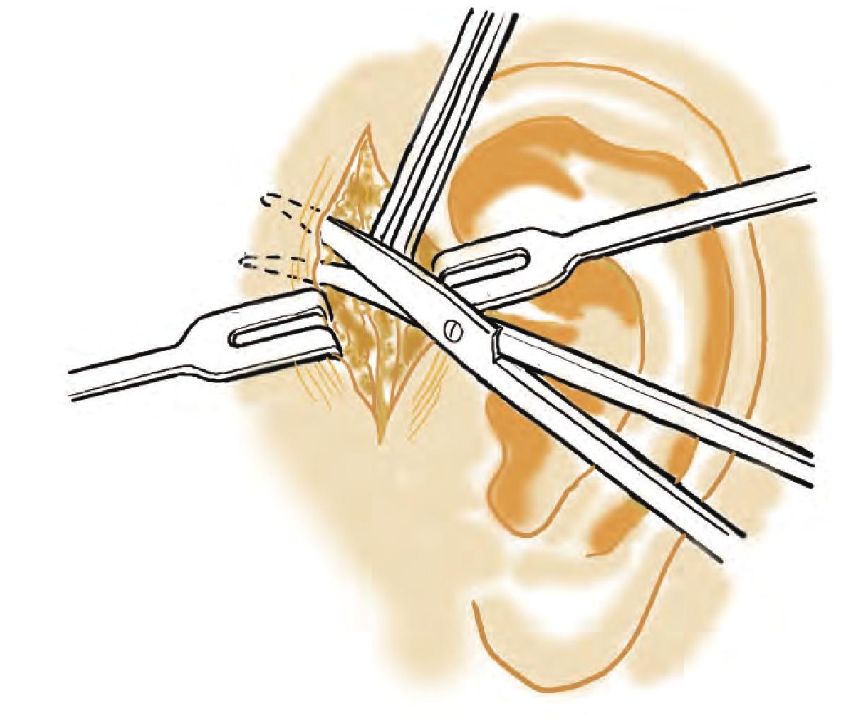 第一节 先天性耳前瘘管切除术