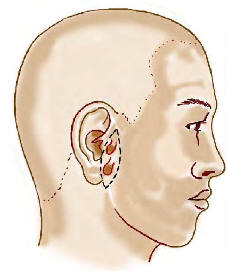 第五节 副耳整形术