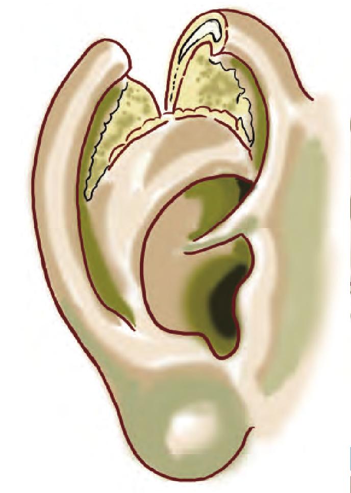 第六节 巨耳整复术