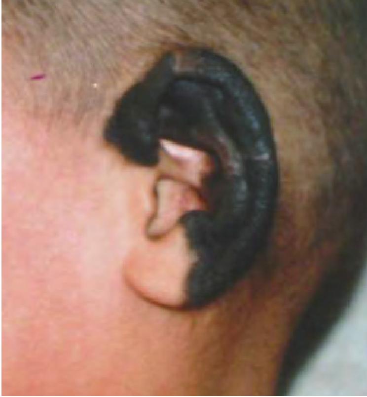 第十节 耳郭皮肤病变切除术