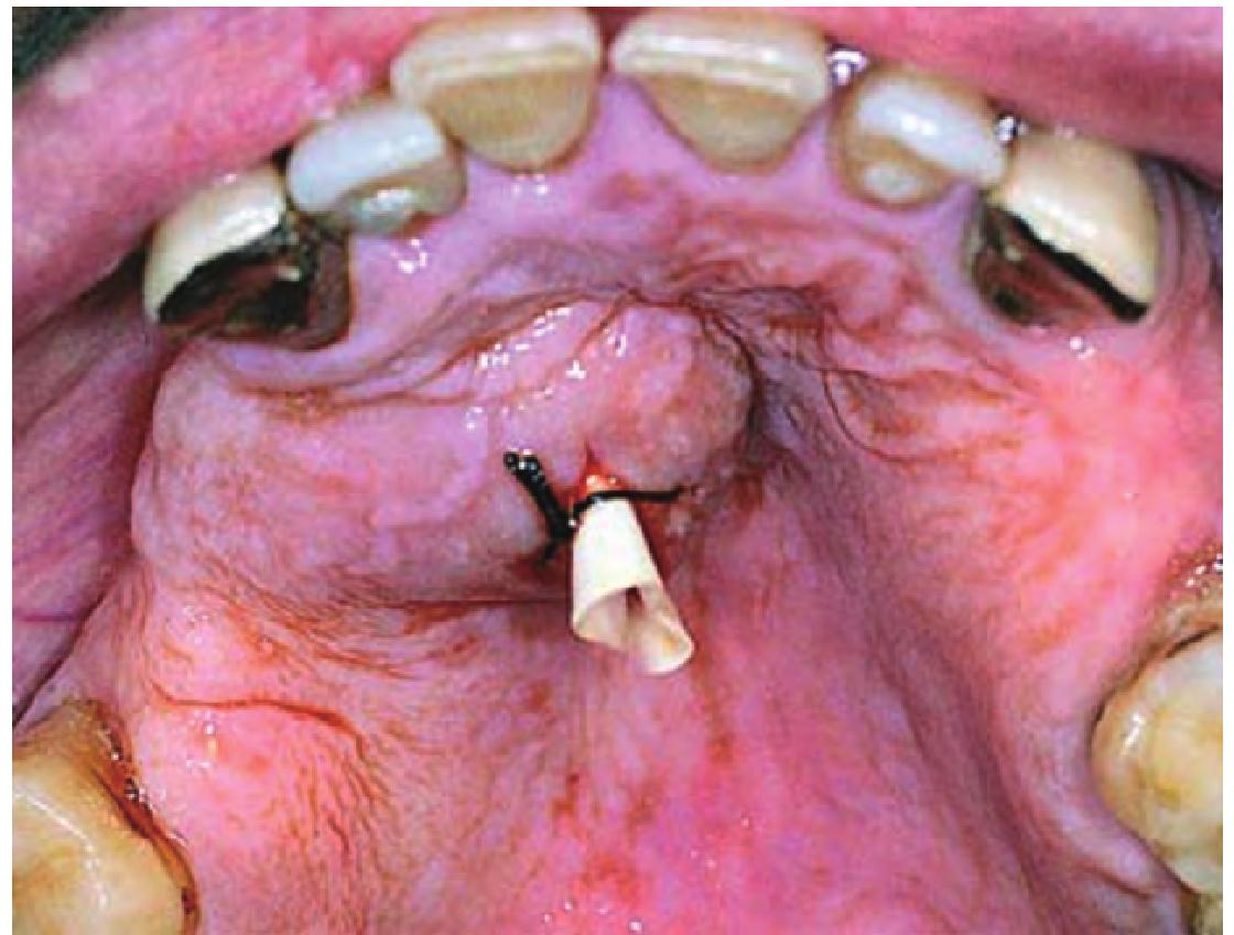 第二节 冠周脓肿及牙槽脓肿切开引流术