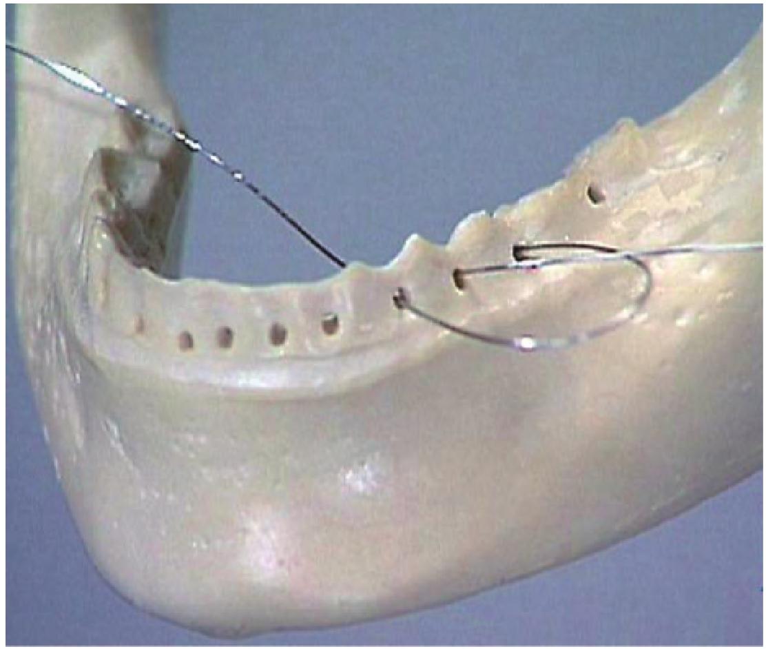 第十节  金属丝颌间结扎固定术