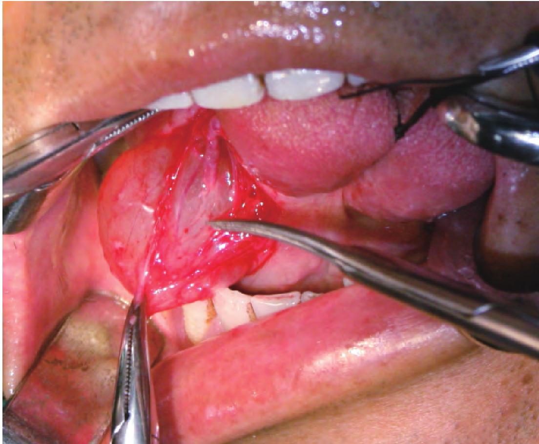 第二节 舌下腺切除术