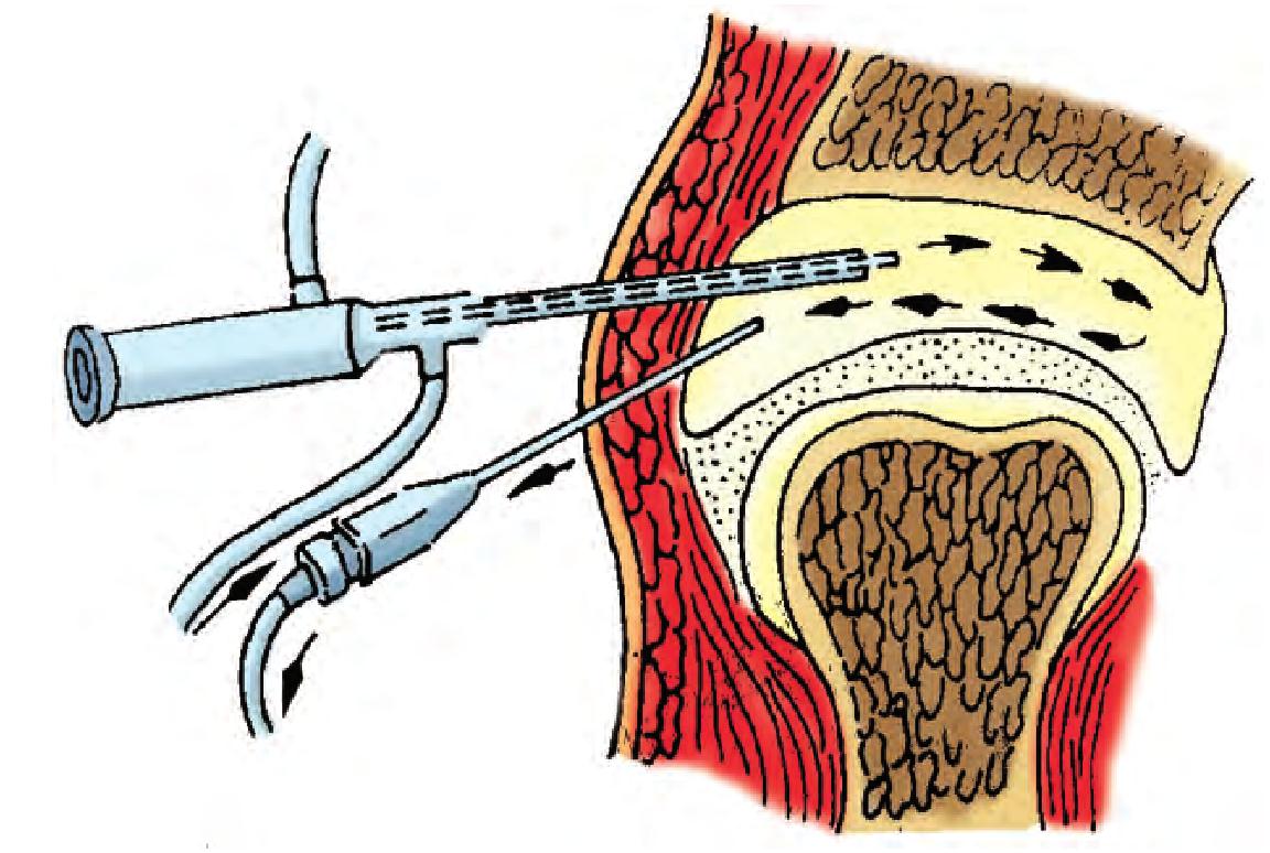 第十节  诊断性颞下颌关节镜及关节灌洗术