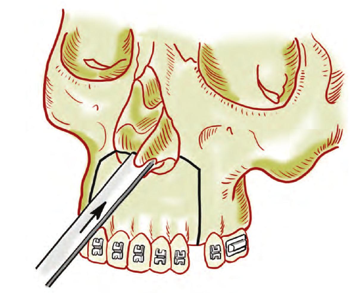 第二节  上颌前部骨切开术