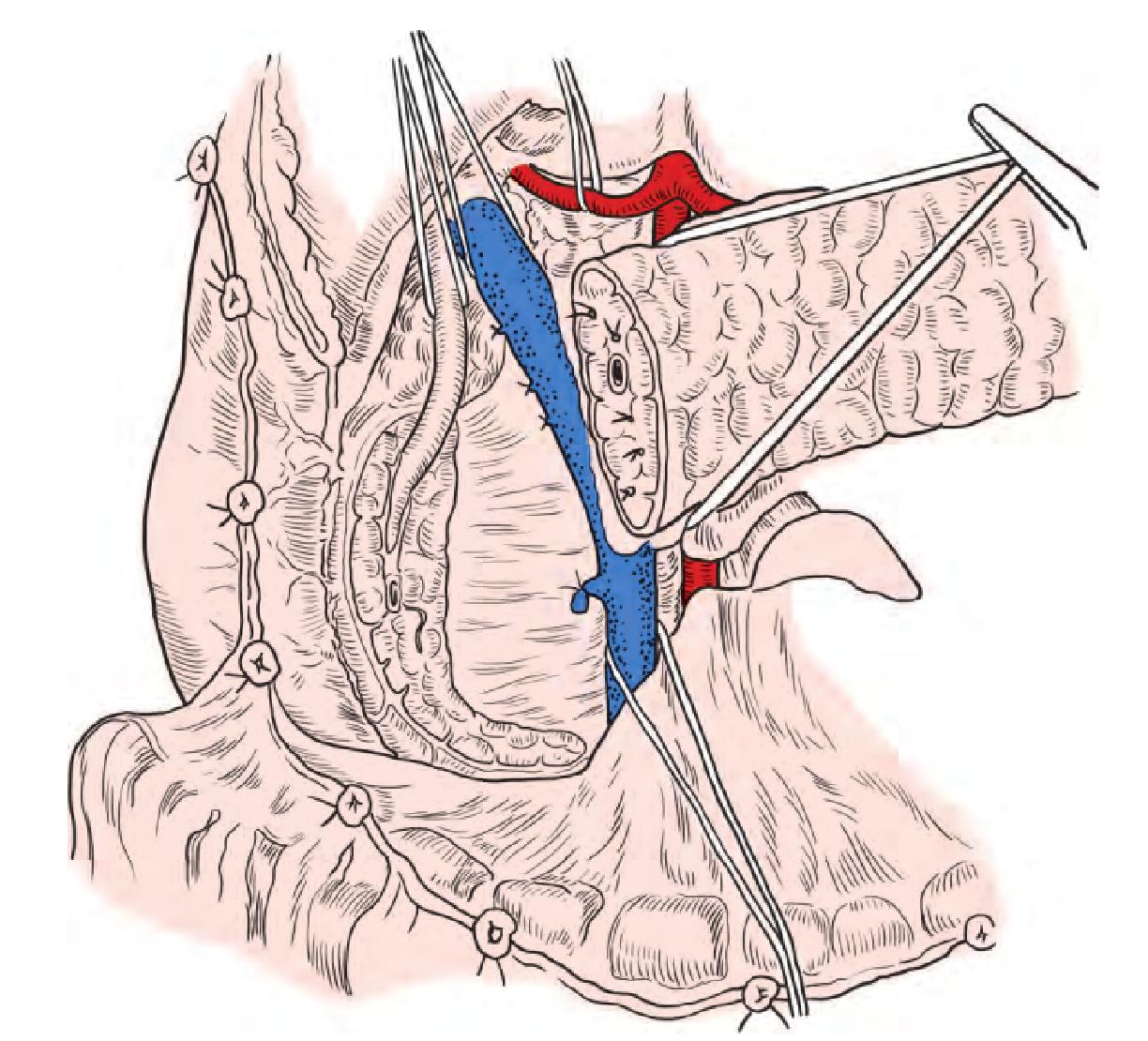 第六节 Beger术（保留十二指肠的胰头切除术，DPPHR)