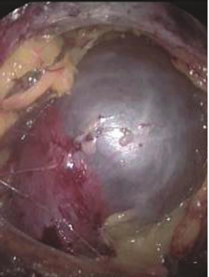 容易被忽視的腎囊腫——囊腫也會變成癌?