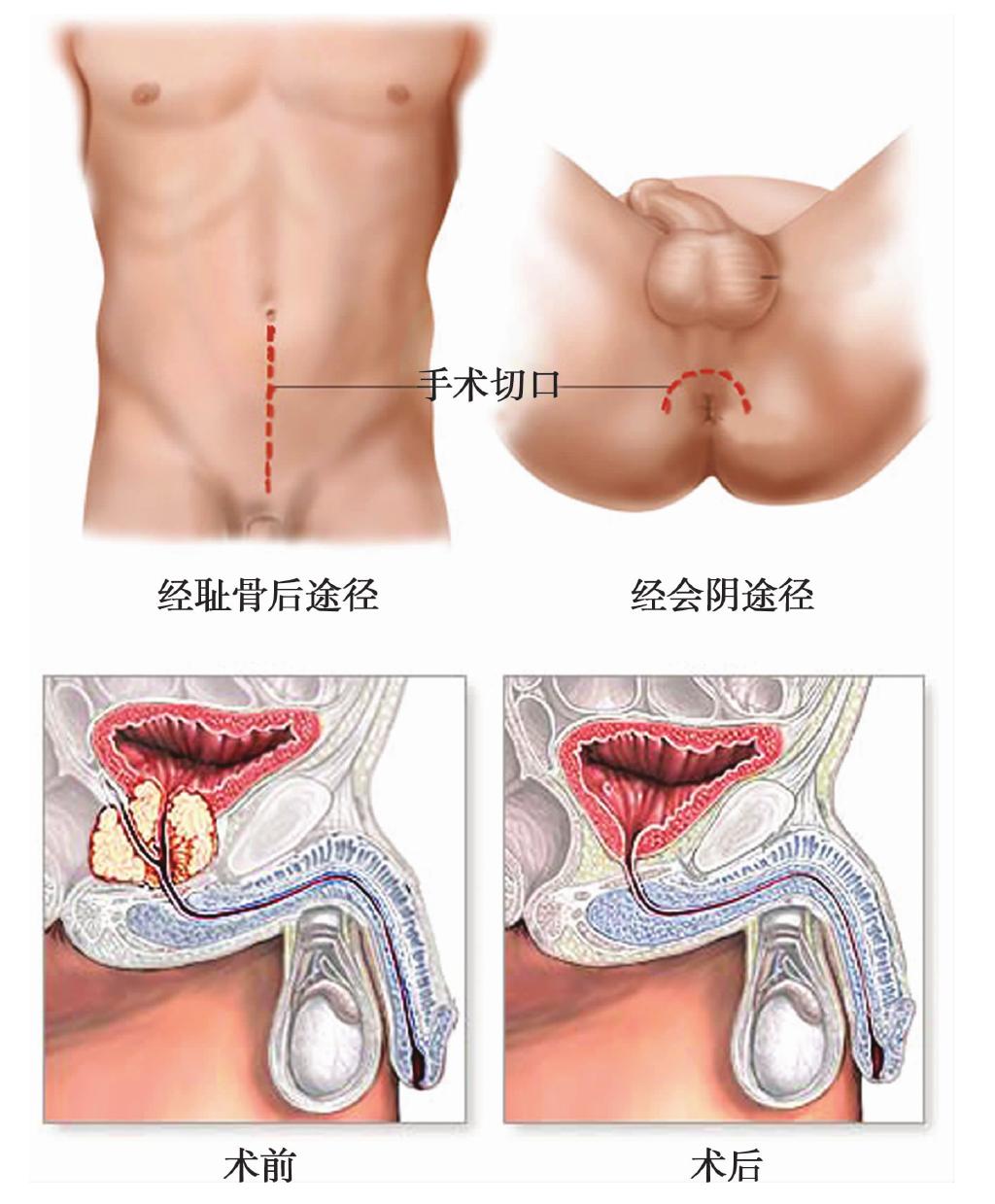 什么是前列腺癌根治術(shù)?