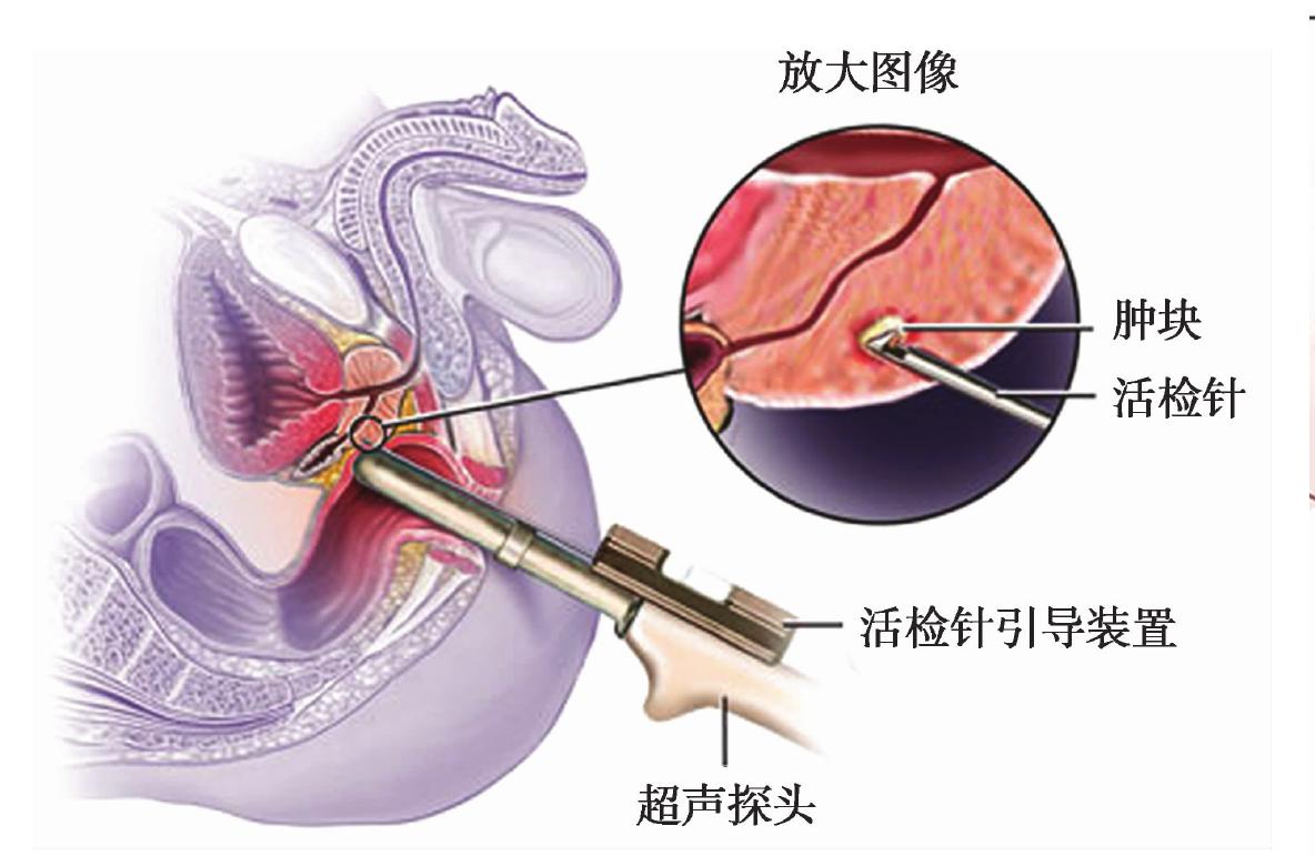 如何進(jìn)行前列腺穿刺活檢?