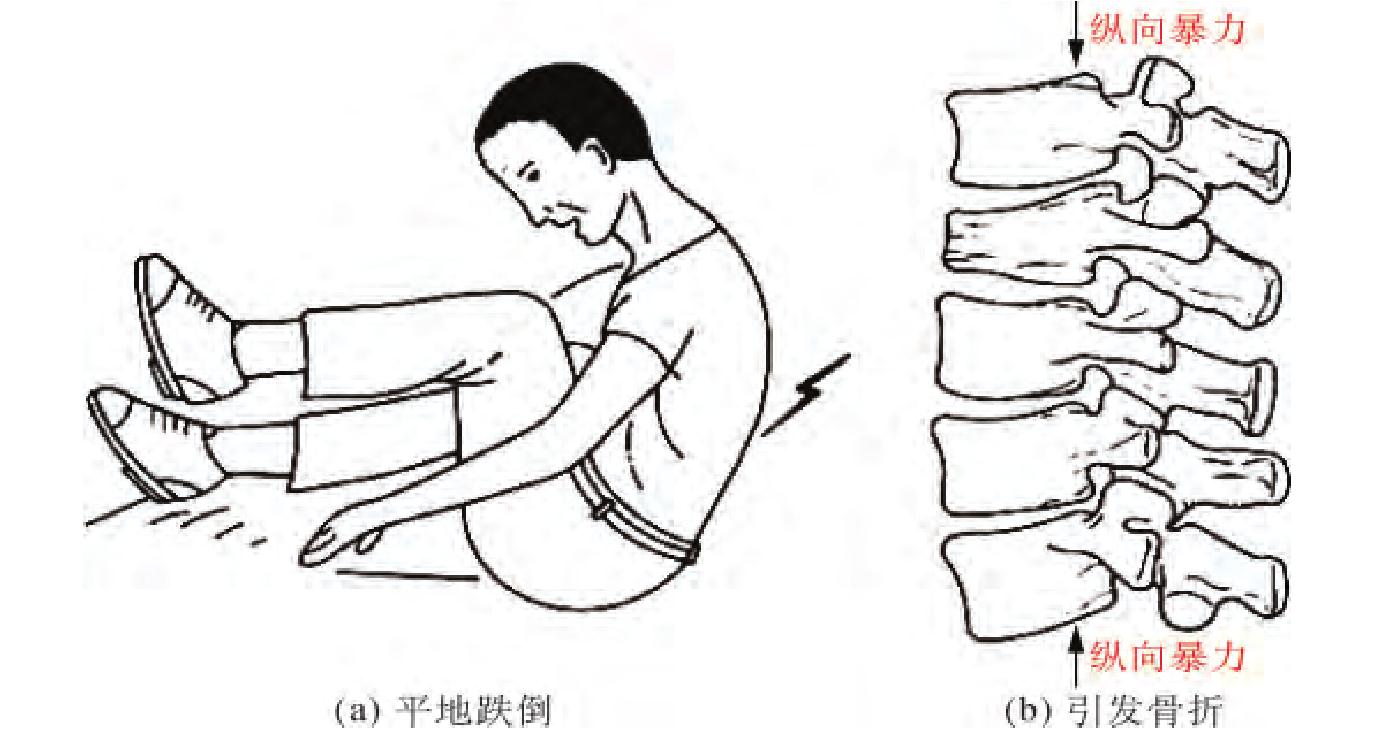 常見的椎體骨折及治療方法