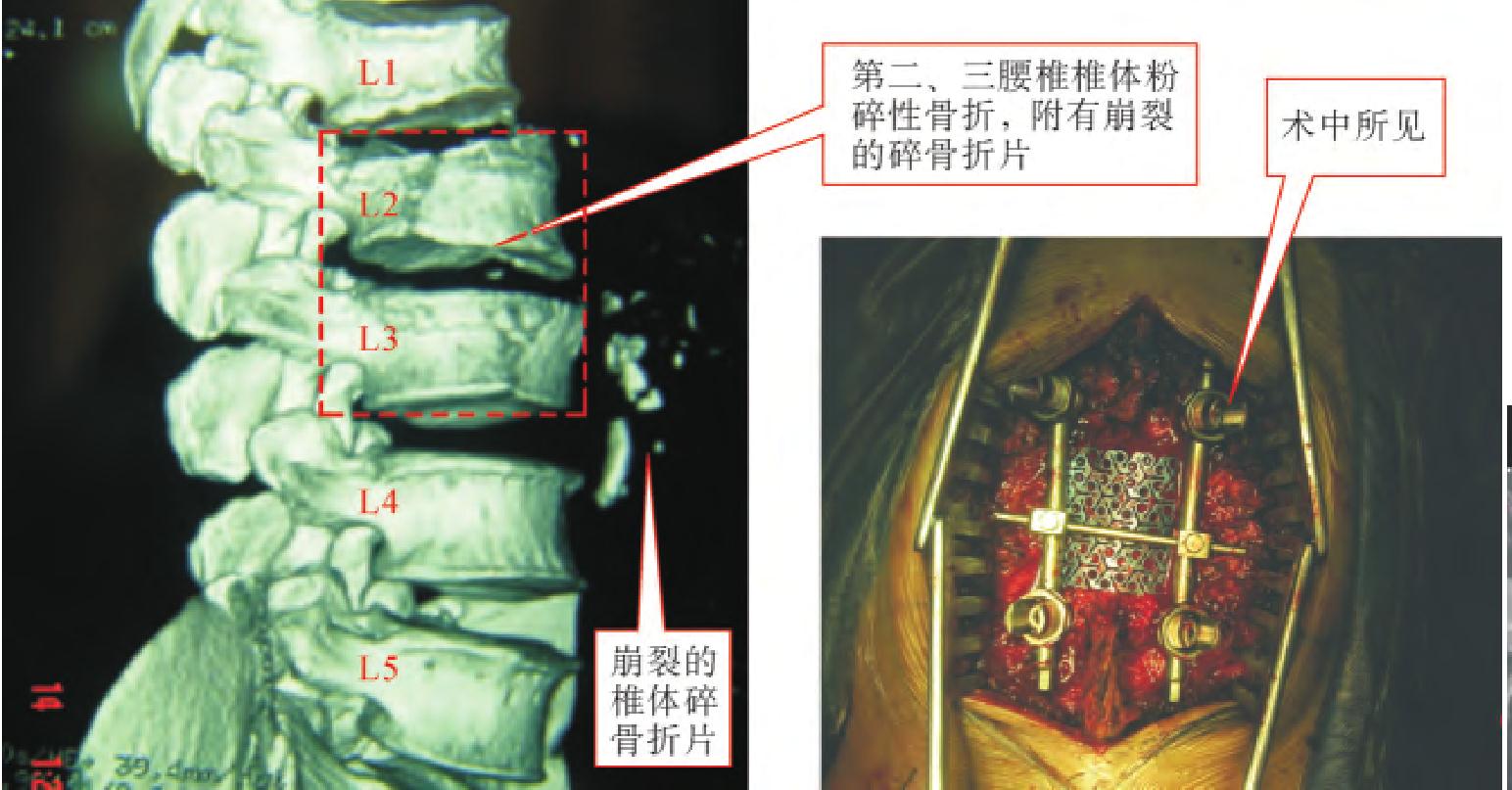 胸椎和腰椎椎體骨折常規(guī)手術(shù)治療