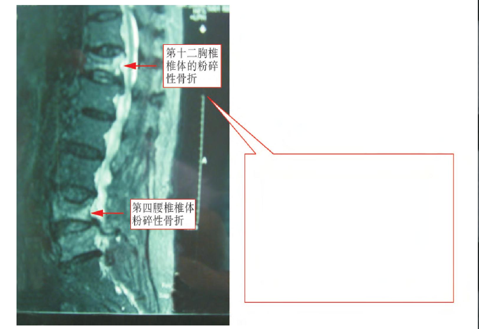 有關(guān)胸椎、腰椎同時(shí)骨折的傷殘鑒定
