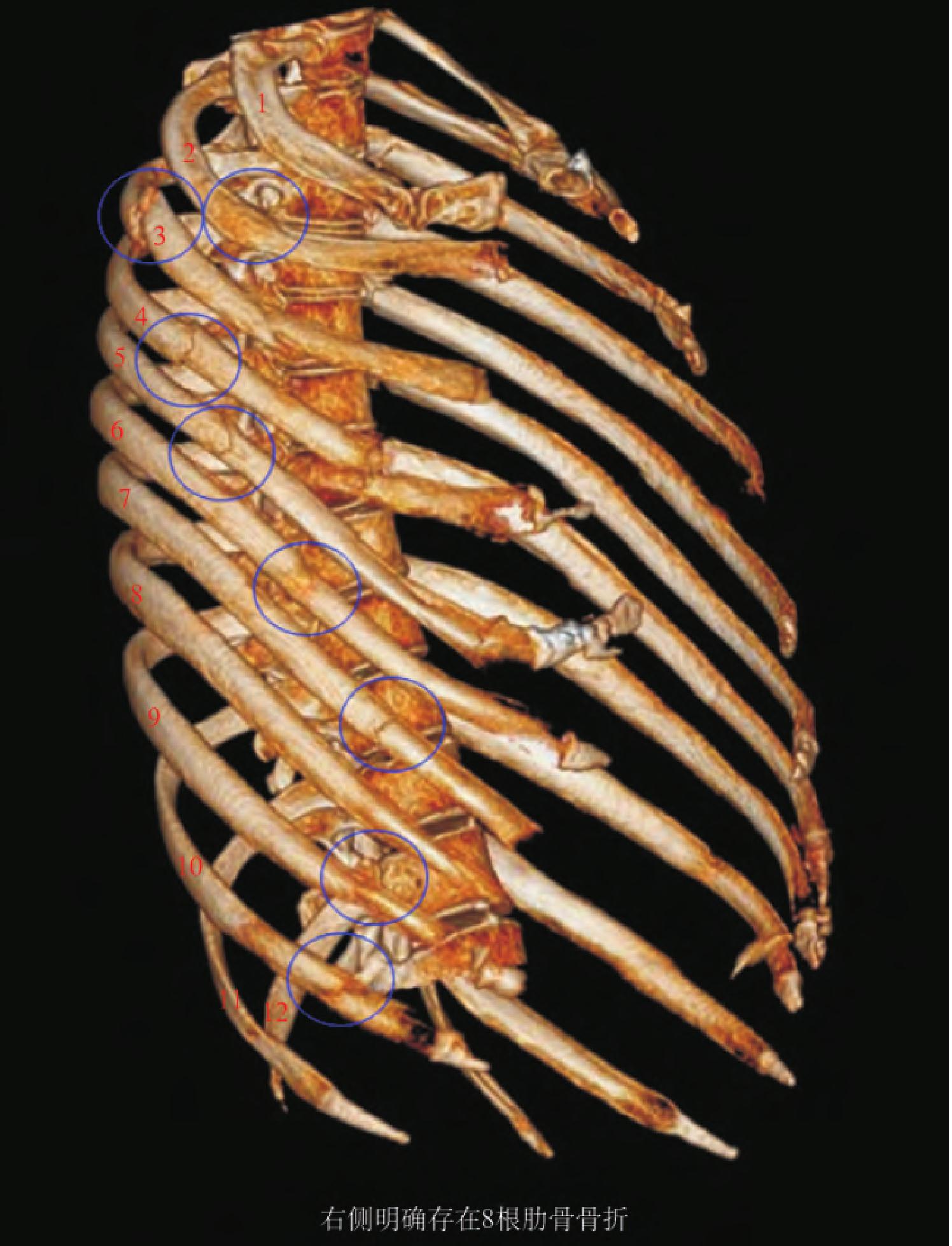 双侧多根单处肋骨骨折，12根以上的肋骨骨折