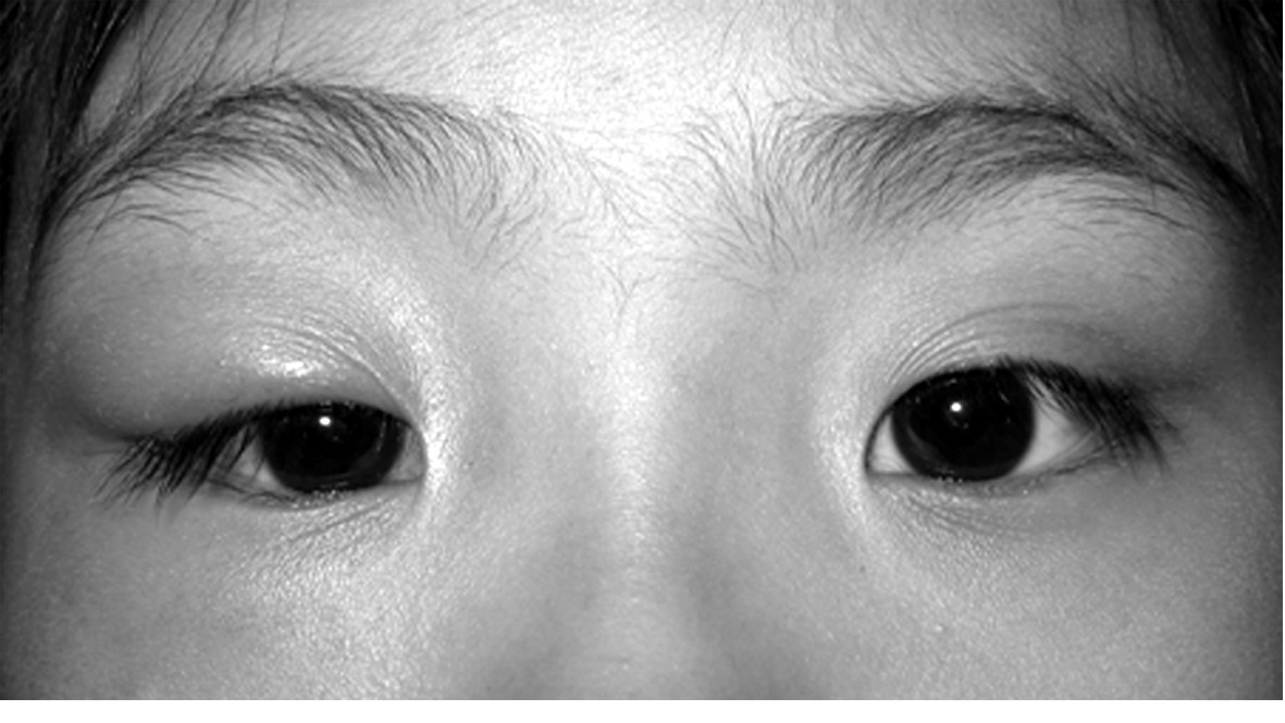 尿毒症眼睑浮肿的图片图片