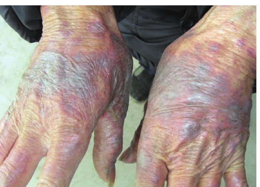老年性紫癜又叫日光性紫癜,以易受外伤的暴露部位如前臂伸侧,手背