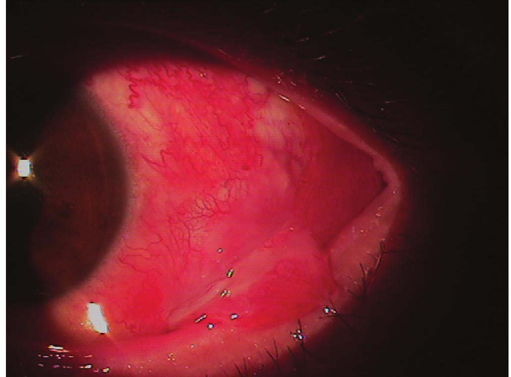 结膜半月襞红肿变大图片
