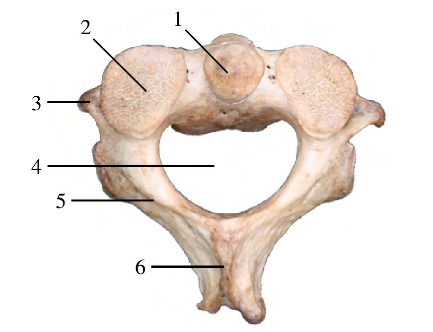 图1-6 枢椎(上面观)