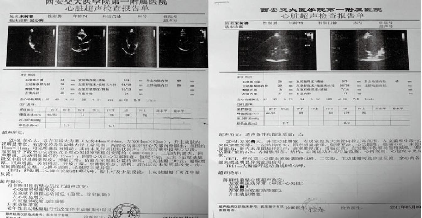 胸痹心痛(冠心病 陳舊性心肌梗死、室壁瘤形成)