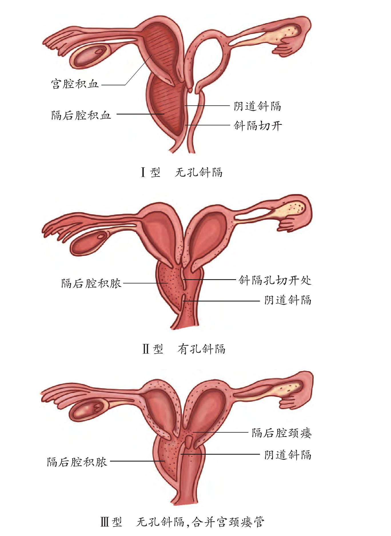 第七節(jié) 陰道斜隔造口術(shù)