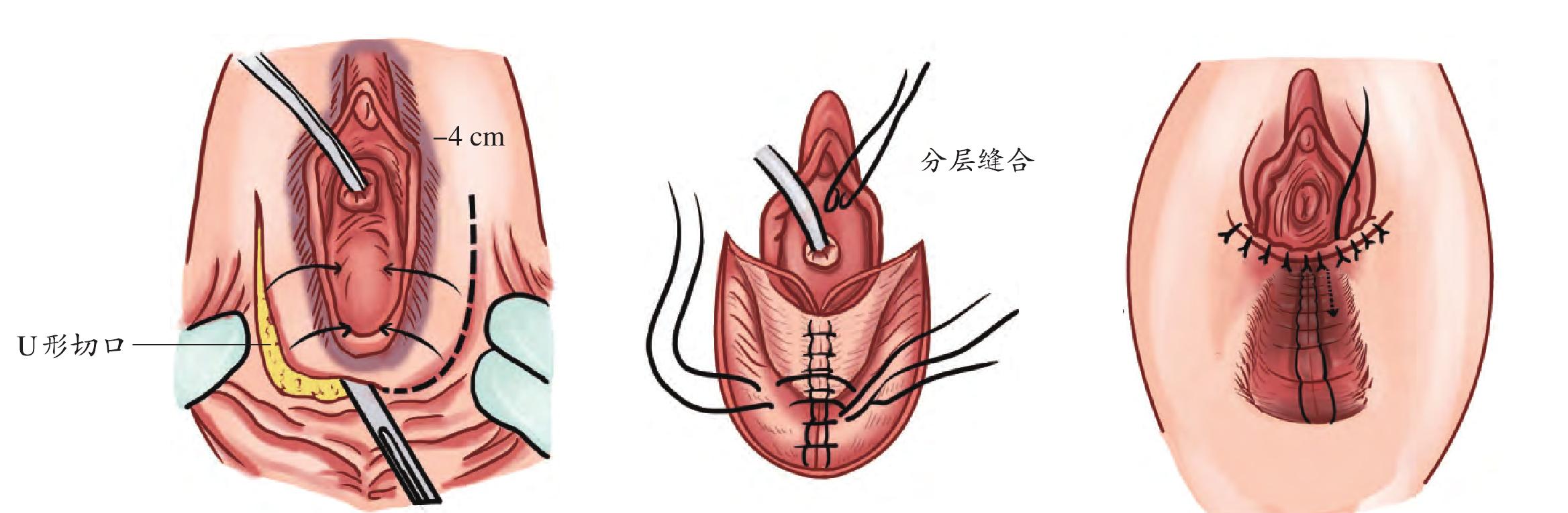 三、魏氏法陰道成形術(shù)