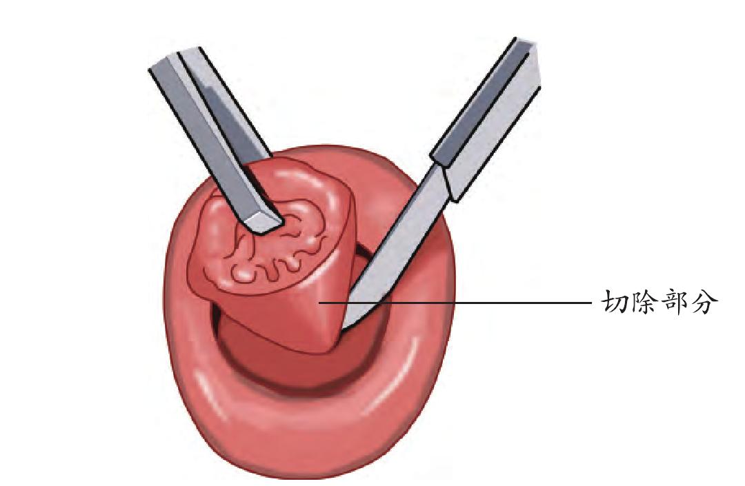 第三节 宫颈冷刀锥形切除术