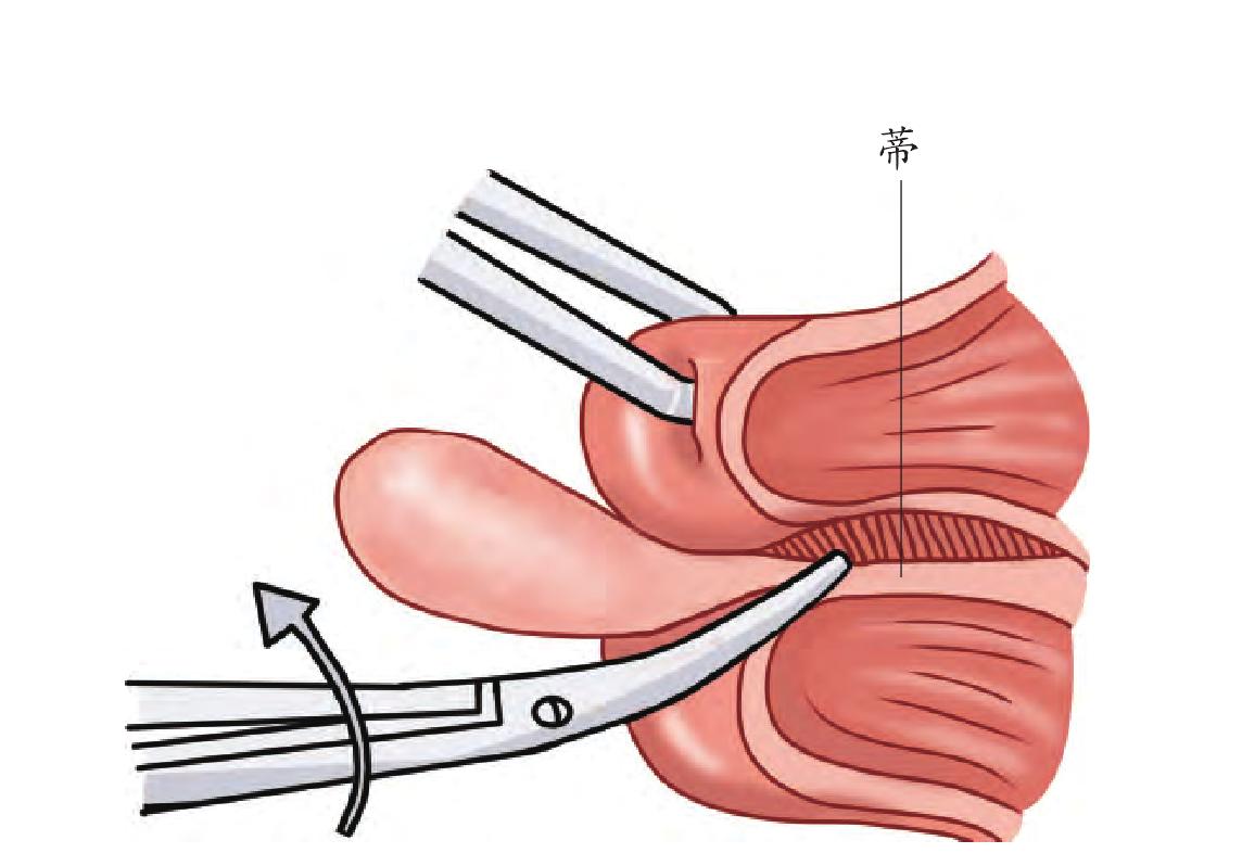 应用解剖宫颈息肉大多来自宫颈管黏膜,单发或多发