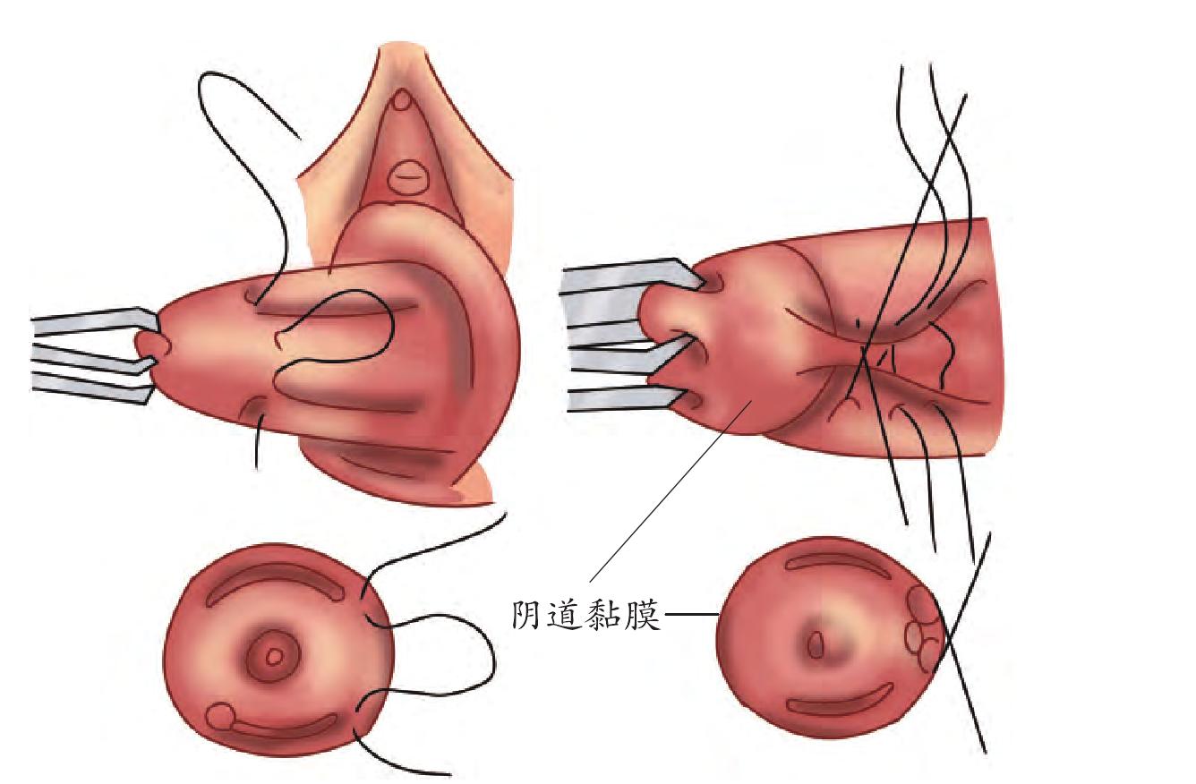 手术指征阴道闭合术仅适用于重度子宫或阴道穹隆脱垂且没有性生活要求