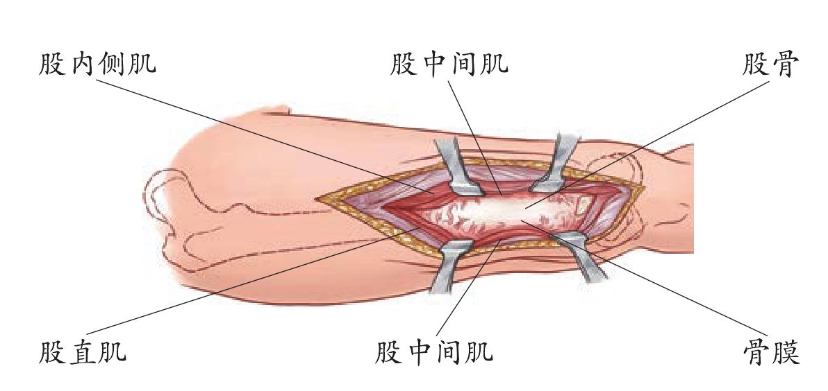 四、股骨中下段的前內(nèi)側(cè)入路