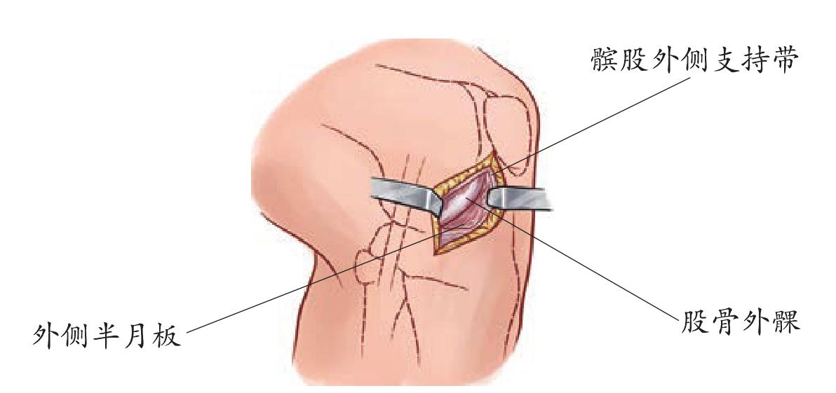 三、前外側(cè)入路