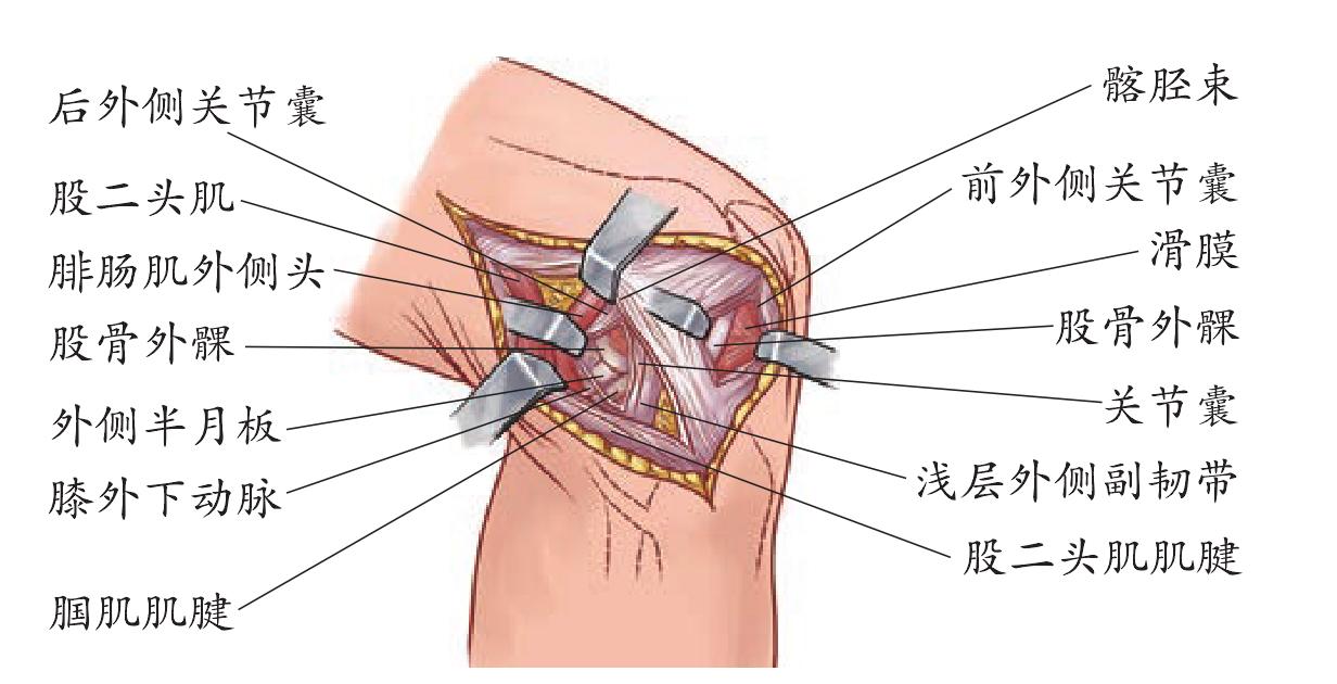 五、外側(cè)入路
