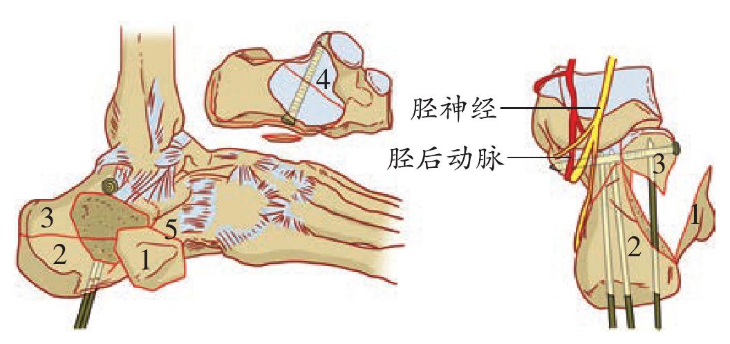 第三十六节 跟骨骨折切开复位内固定术