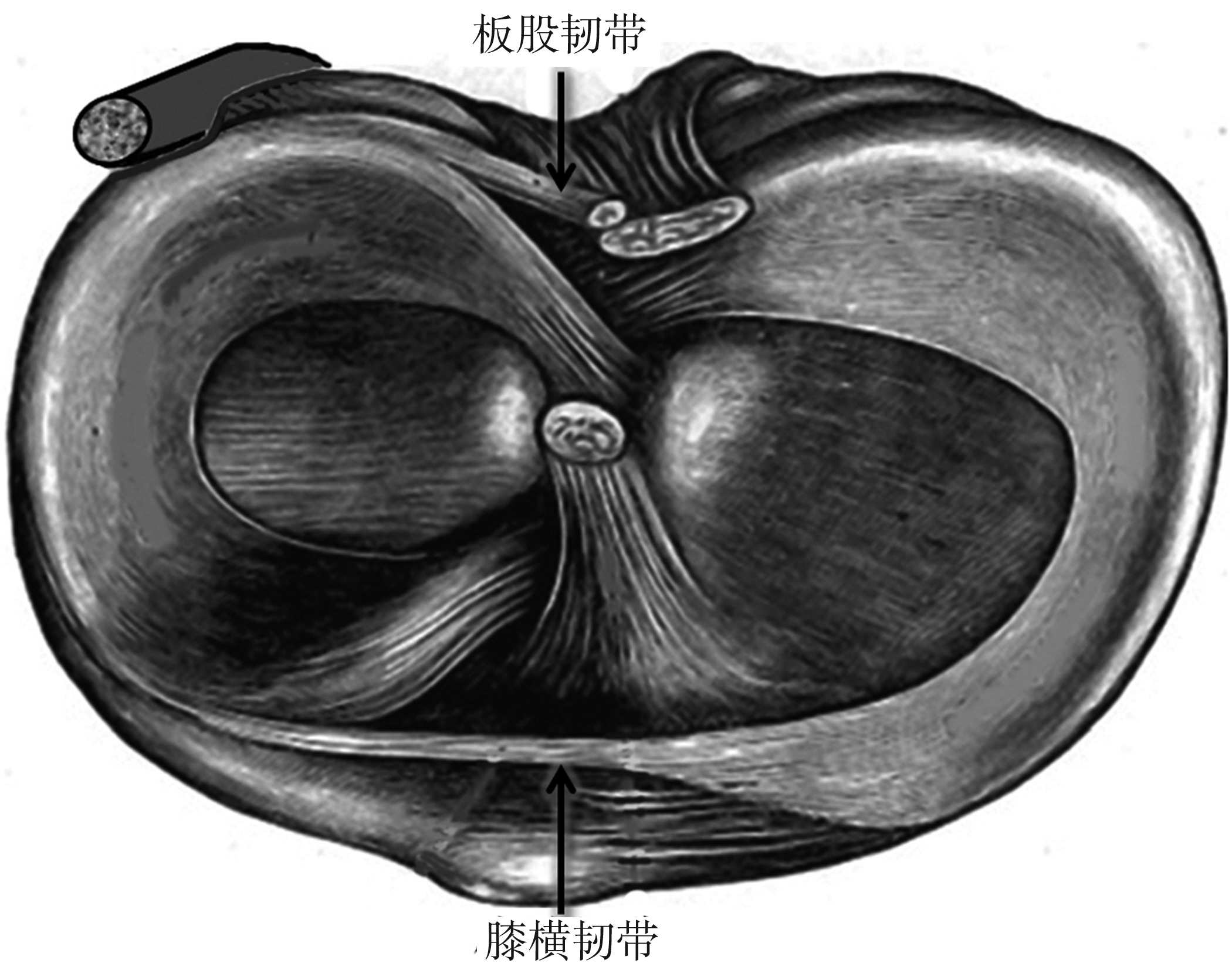 第一節(jié) 半月板損傷的治療策略