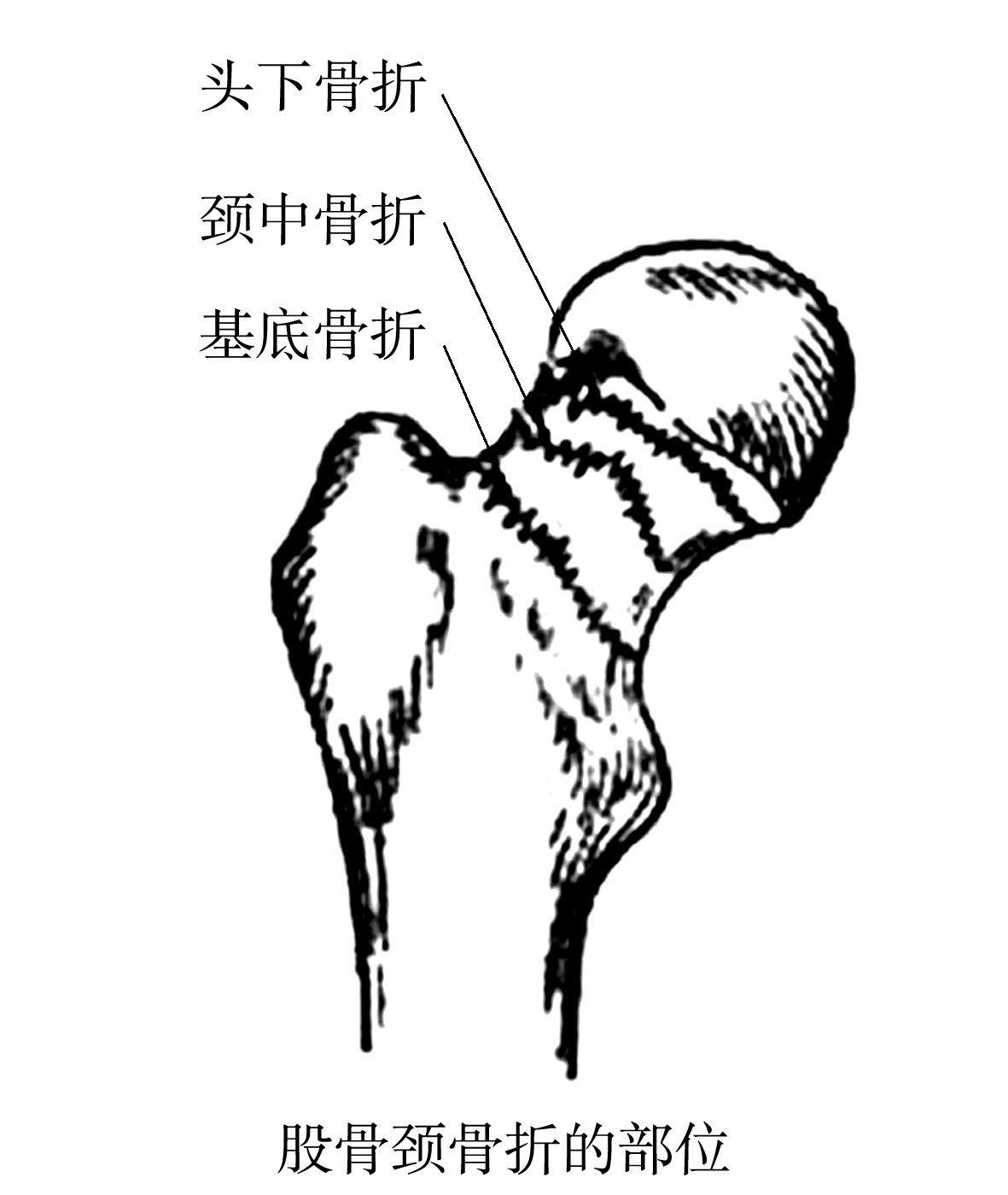2.1　股骨頸骨折