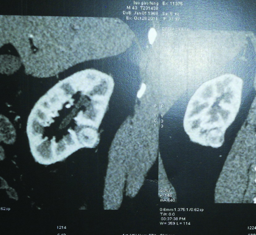 第五節(jié) 腹腔鏡保留腎單位手術(shù)