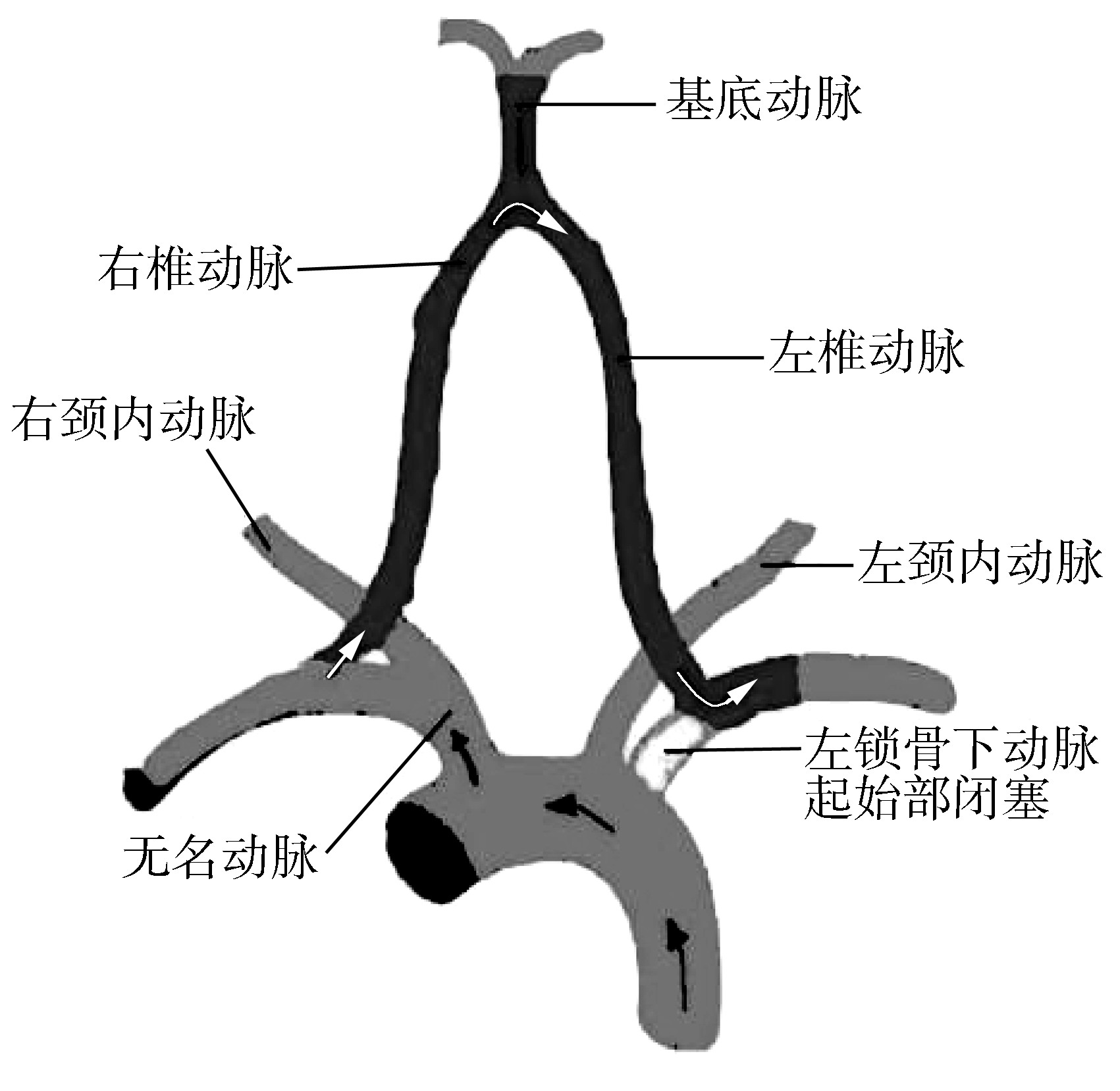 第四節(jié) 腦動脈盜血綜合征