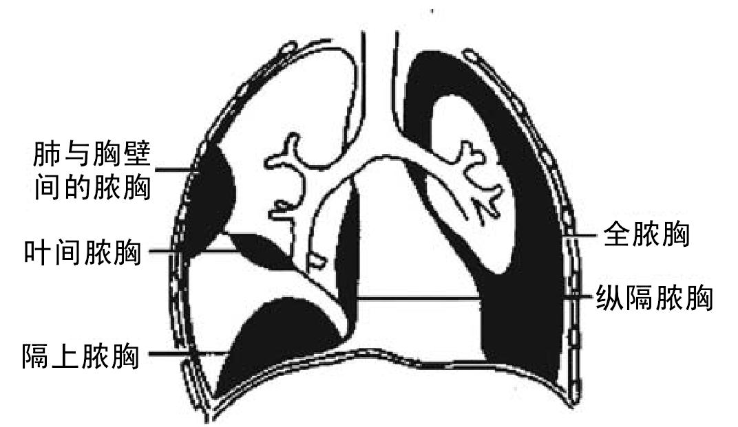 第三節(jié) 常見胸外科呼吸系統(tǒng)疾病