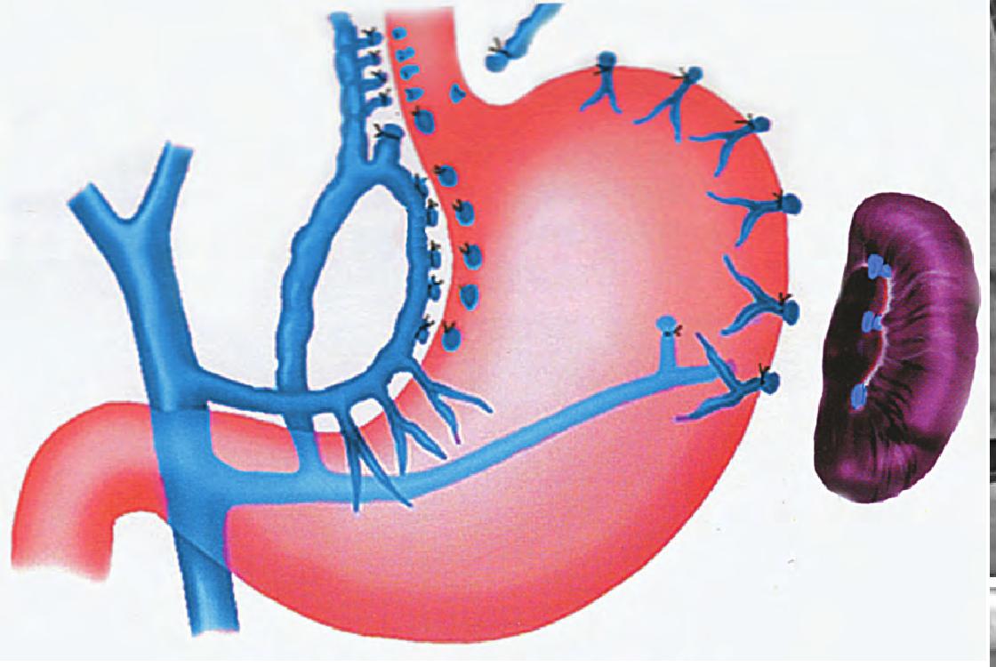 门奇静脉断流术图片