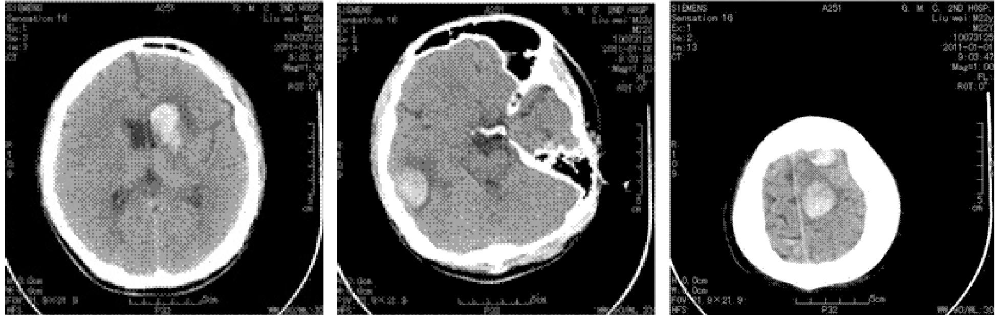 以脑出血为首发表现的肝豆状核变性一例