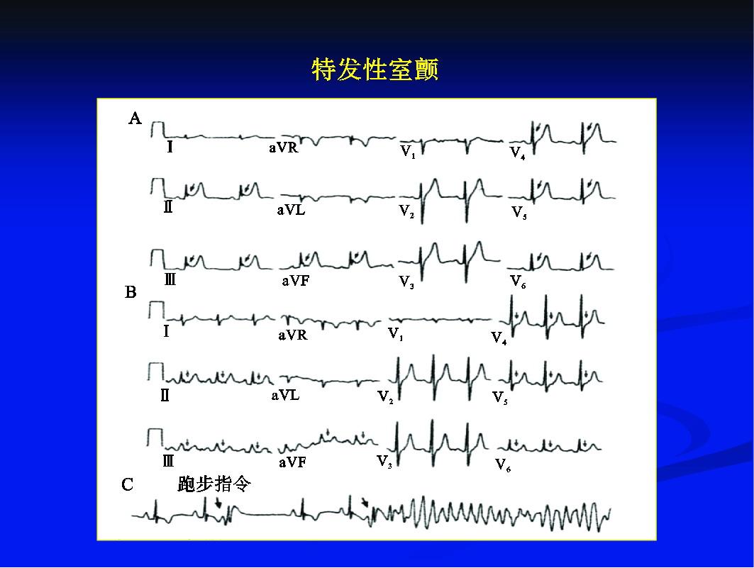 二十七、特發(fā)性室顫