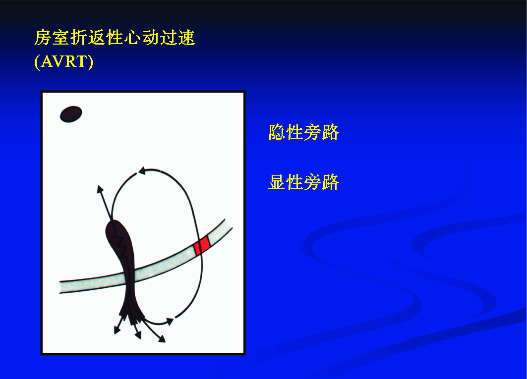 十、房室旁路顯性與隱匿傳導(dǎo)