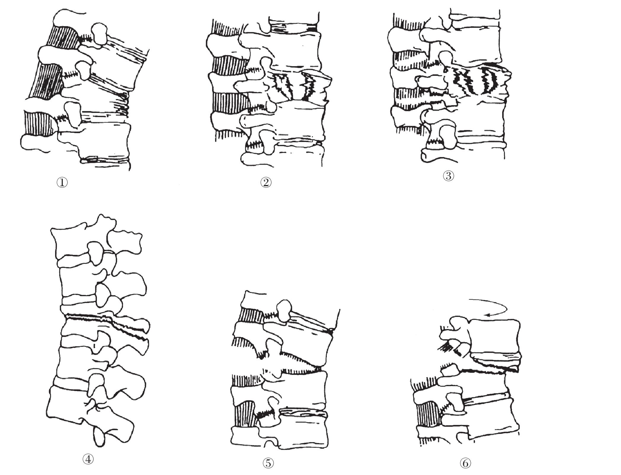 第三节 脊柱和脊髓损伤